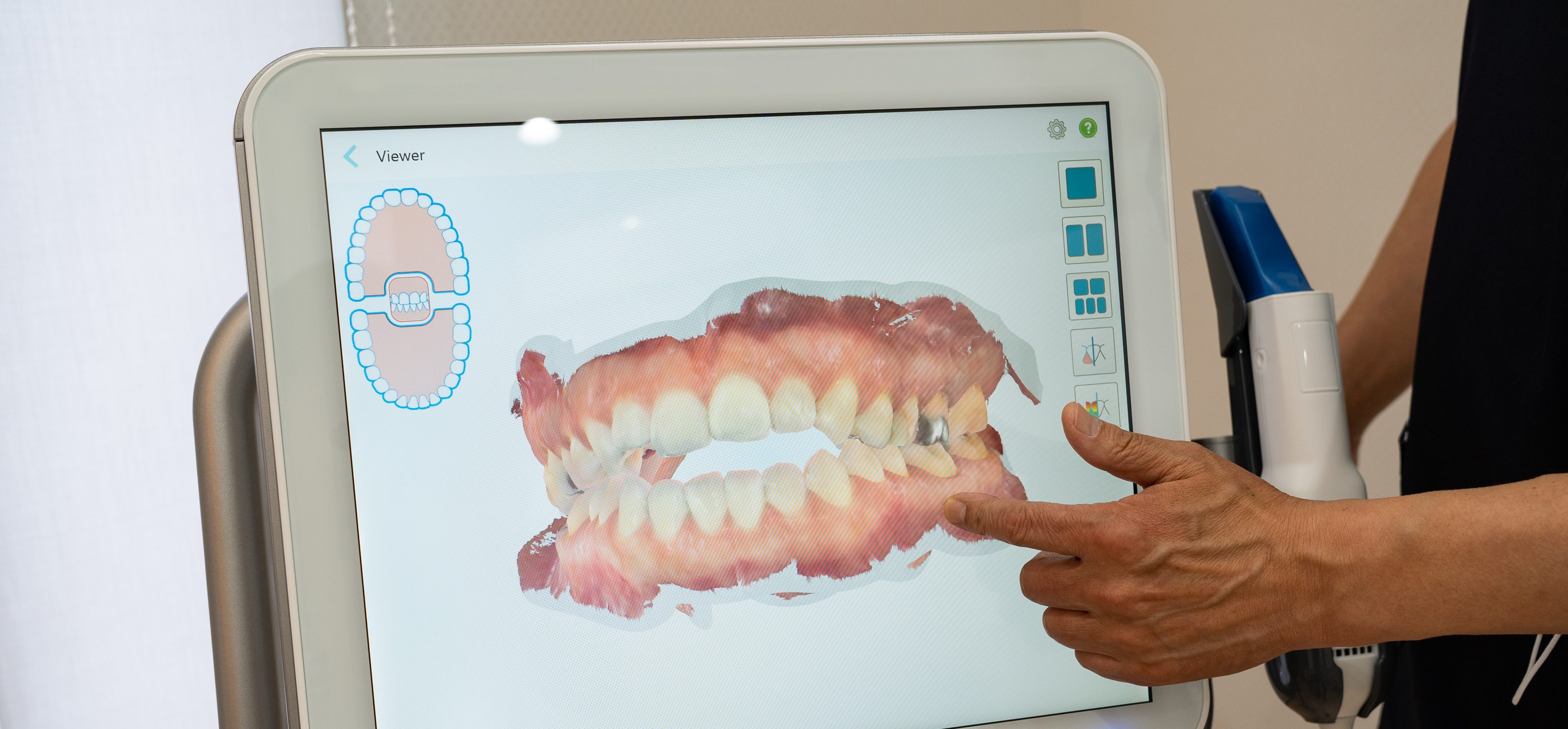 矯正用光学3Dスキャナー：iTero｜今村歯科・矯正歯科医院