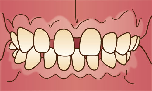 不正咬合（空隙歯列）