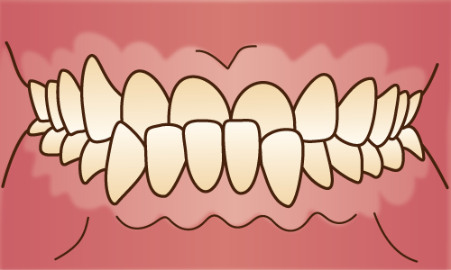 不正咬合（下顎前突）